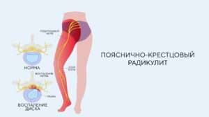 пояснично-крестцовый синдром